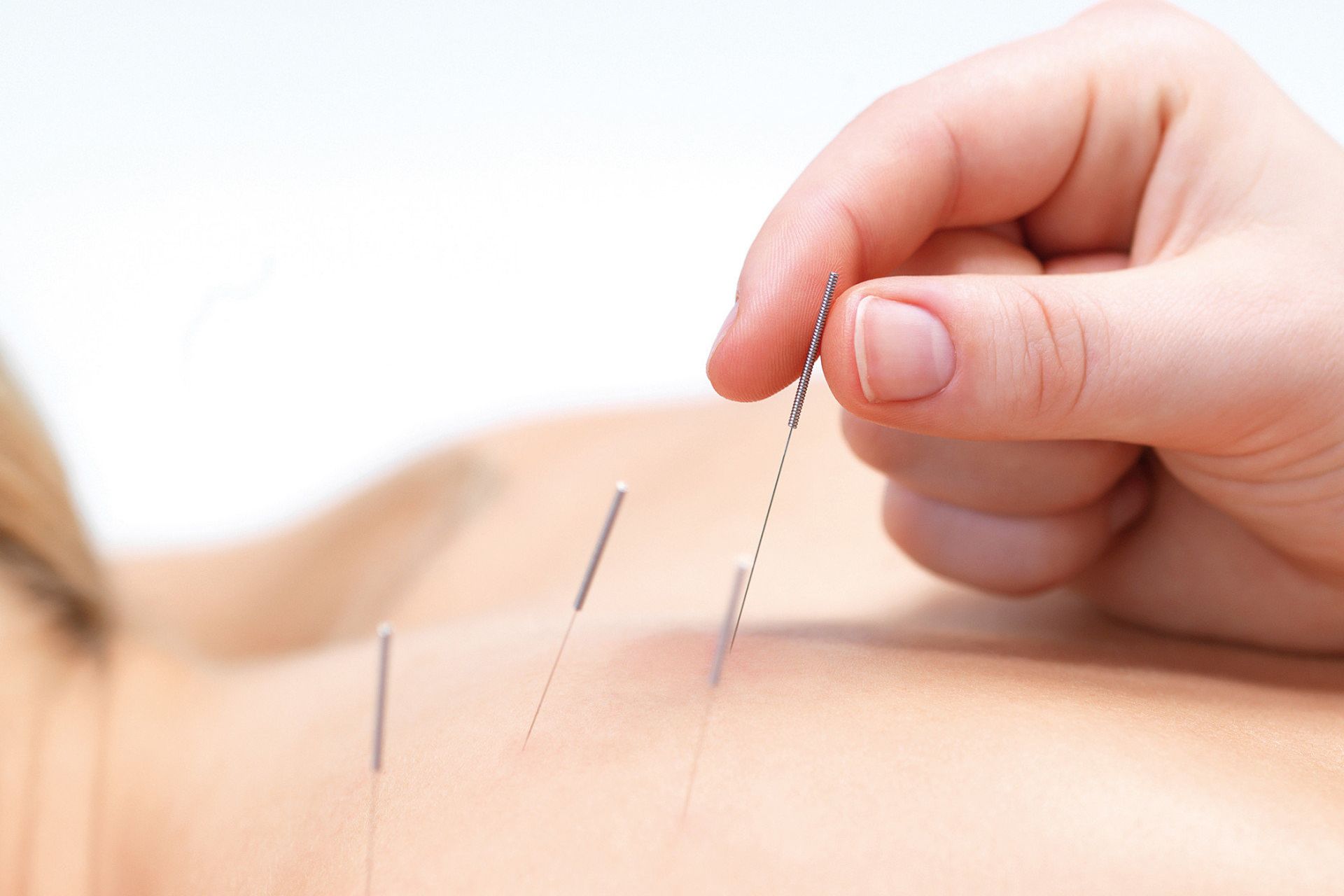 Akupunkturnadeln werden am Rücken angebracht